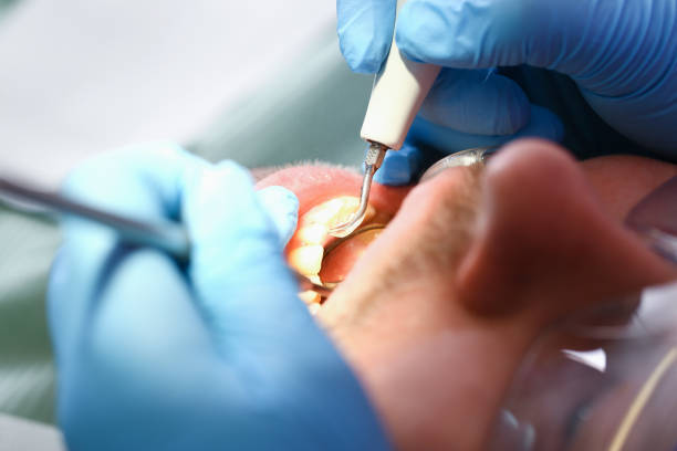 Best Broken or Cracked Tooth Emergency Dentist in Bertsch Oceanview, CA